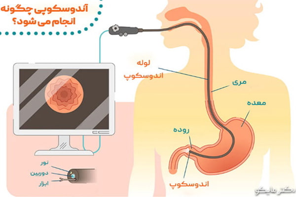 آندوسکوپی چیست و چقدر طول می کشد؟