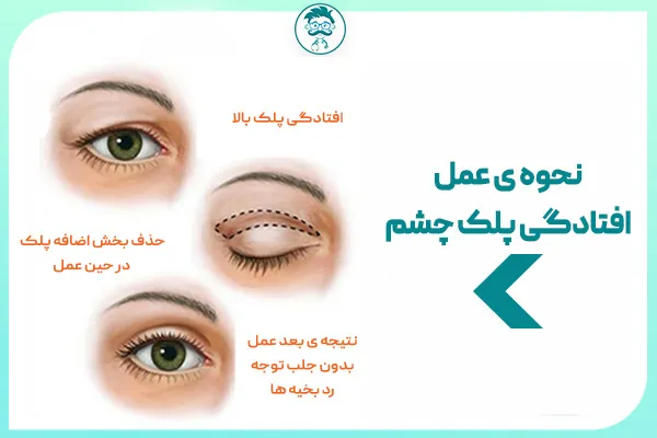 عمل افتادگی پلک چشم
