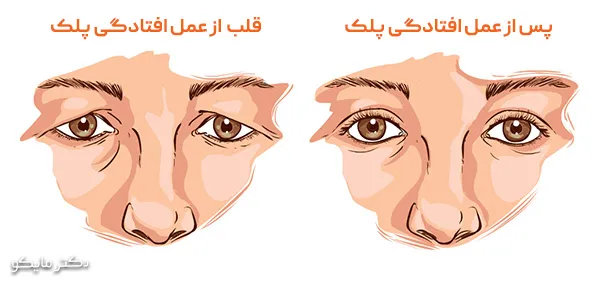 عمل افتادگی پلک (پتوز) در بزرگسالان چگونه است؟