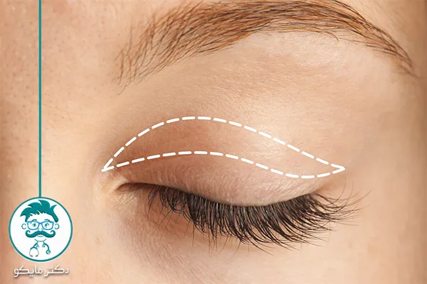 درمان خانگی افتادگی پلک چشم 