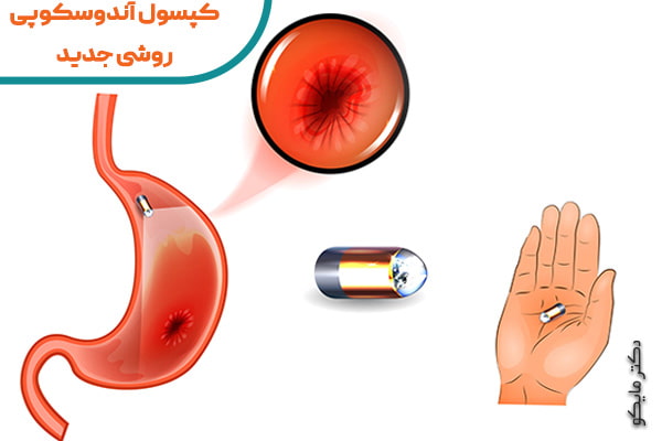 کپسول آندوسکوپی چیست؟