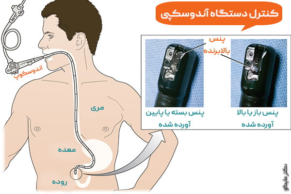 ترس از درد آندوسکوپی: آیا آندوسکوپی درد دارد؟