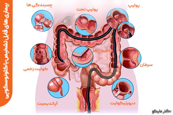 فیلم عمل /جراحی کولونوسکوپی