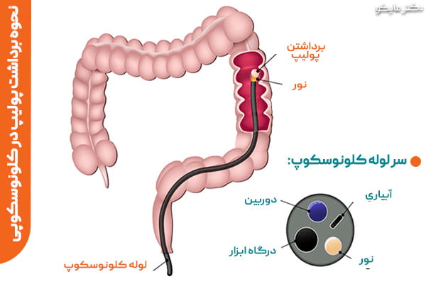 کولونوسکوپی روده بزرگ چیست؟