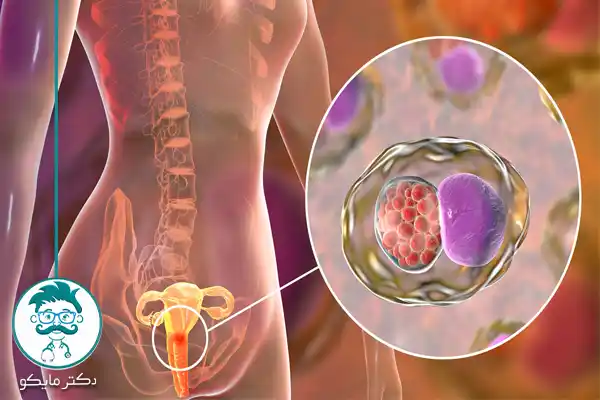 عوارض ناشی از کلامیدیا درمان نشده در زنان