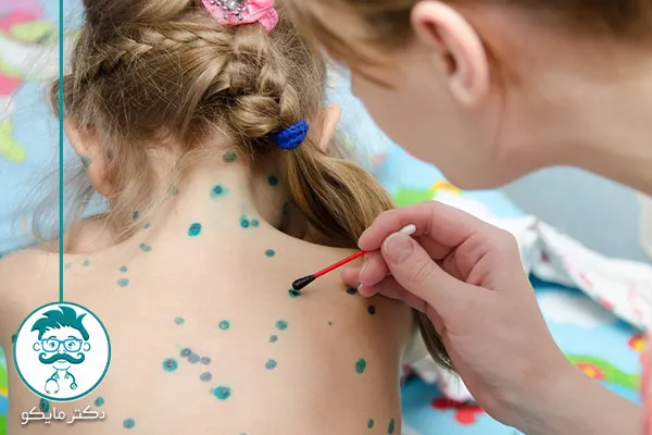 برای آبله مرغان چی بخوریم؟