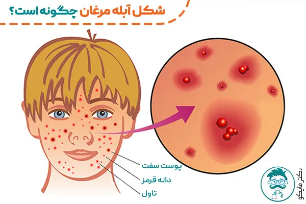 شکل آبله مرغان چگونه است؟