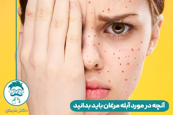 آبله مرغان چیست؟