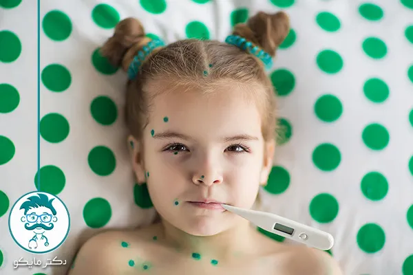 بیماری آبله مرغان در کودکان