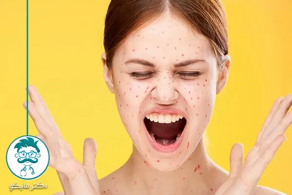 آبله مرغان چگونه منتقل می شود؟