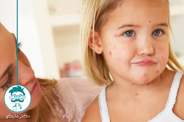 برای درمان بیماری سرخک چه غذاهایی مصرف کنیم؟