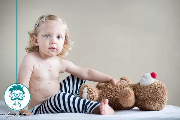 روش‌های درمان بیماری سرخک