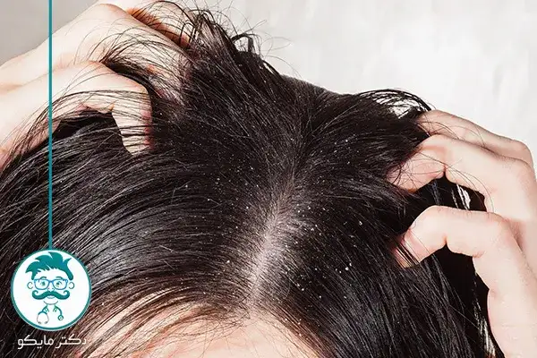 درمان رشک سر با رنگ مو