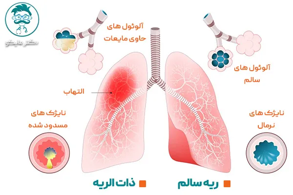 ریه سالم و ذات الریه