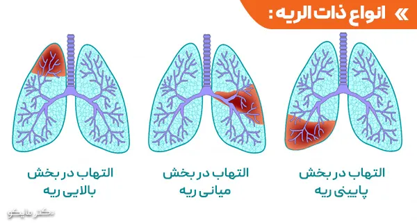 انواع ذات الریه 