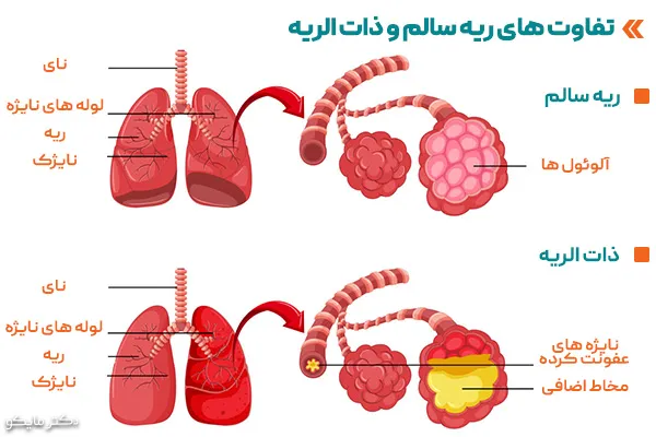 ذات الریه و کرونا