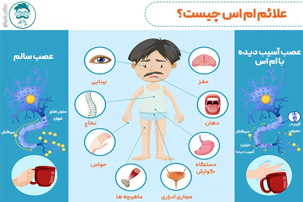 علائم ام اس چیست؟