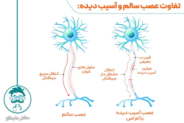 عصب آسیب دیده در بیماری ام اس 