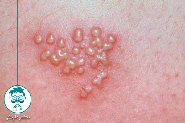 علائم تبخال پوست