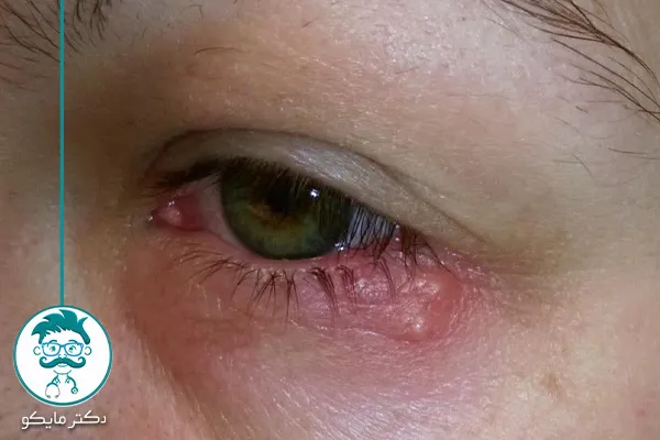 مراحل عفونت تبخال