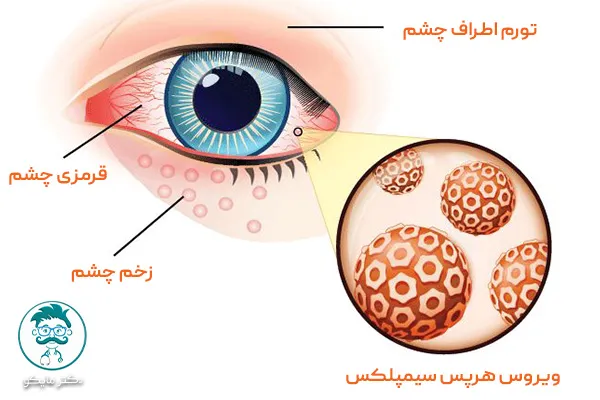ویروس هرپس سیمپلکس