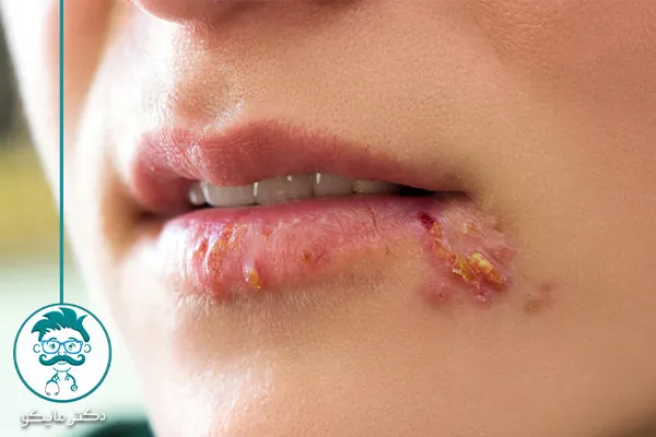 وازلین و خمیردندان برای درمان تبخال