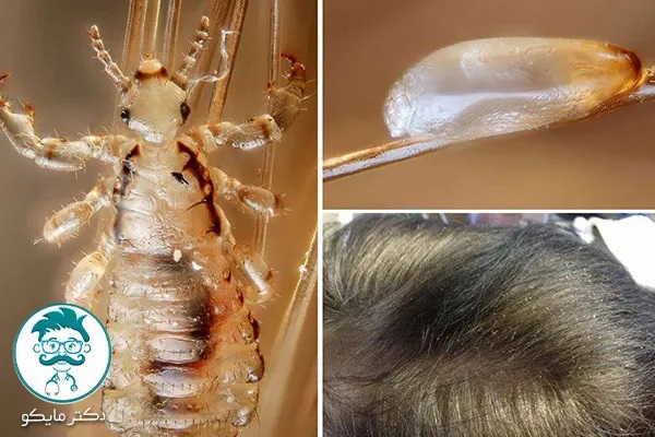 شپش بالغ سر