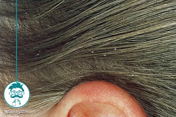 بیشترین شپش سر در کجا یافت می شود؟