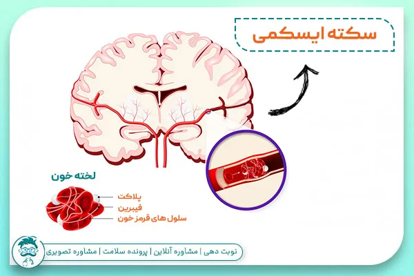نگهداری و مراقبت از بیمار سکته مغزی در منزل
