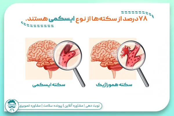 سکته ایسکمی مغزی