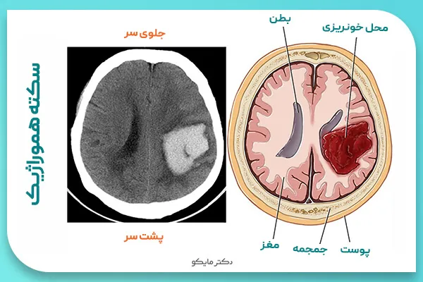 راه‌های پیشگیری از سکته مغزی هموراژیک