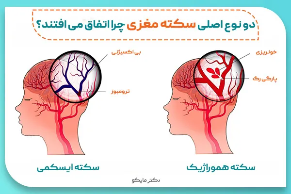 انواع سکته مغزی چیست