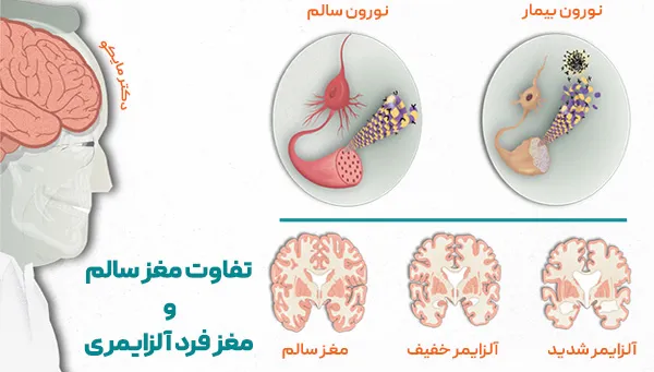 علائم بیماری آلزایمر چیست؟ معجزه درمان آلزایمر دکترمایکو