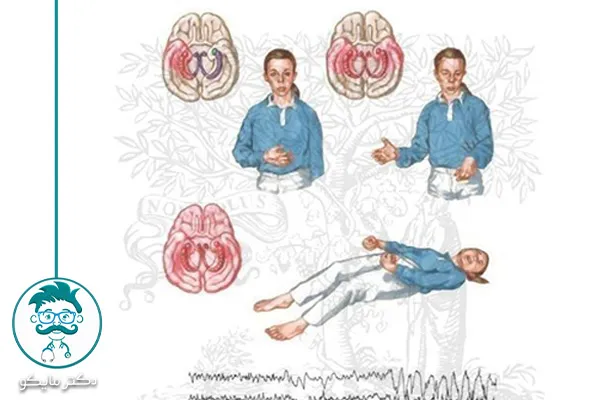 دوای بیماری صرع