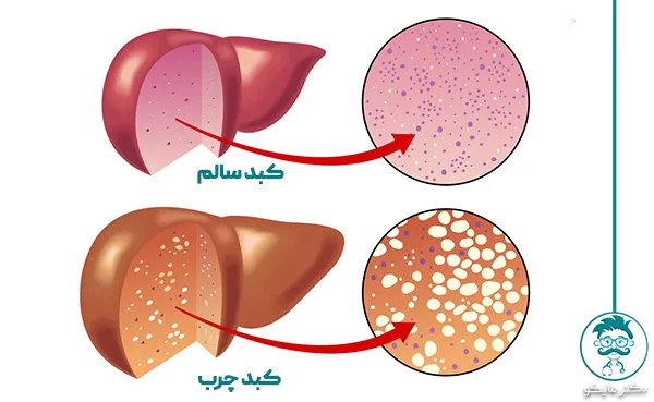 تفاوت کبد چرب و سالم