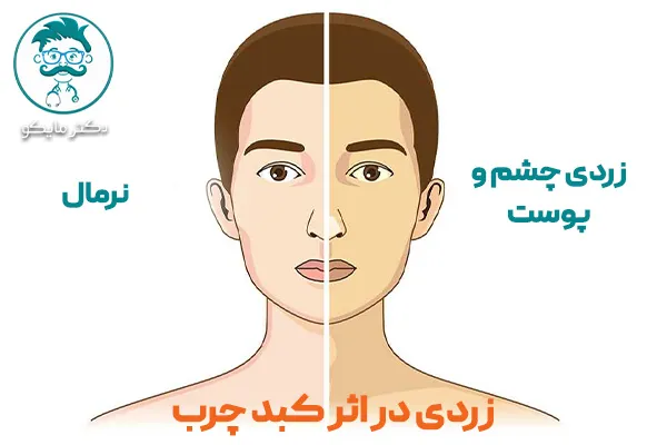 عوارض کبد چرب