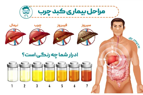 درد کبد چرب چگونه است؟