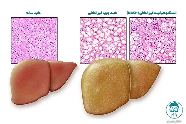 گریدهای کبد چرب
