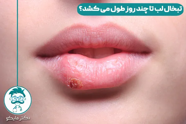 تبخال لب چیست؟