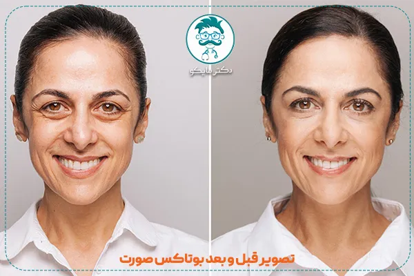 عکس بوتاکس صورت قبل و بعد
