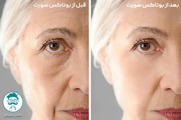 بوتاکس ابرو قبل و بعد
