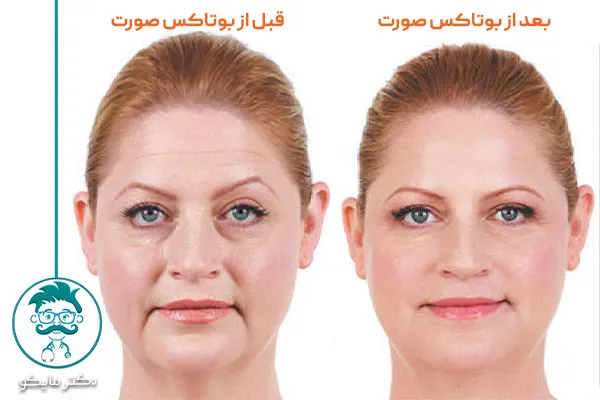 تصویر بوتاکس صورت قبل و بعد
