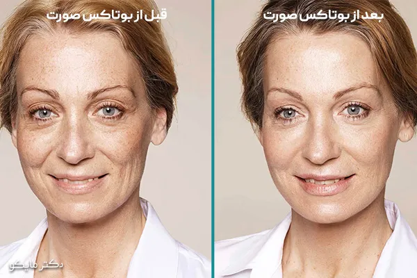 آیا بوتاکس باعث افتادگی پوست می شود؟