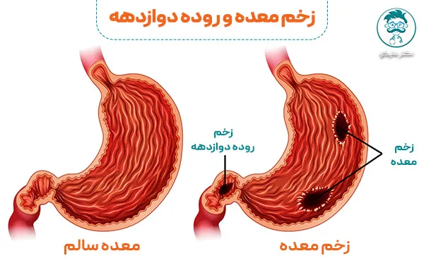 انواع زخم معده