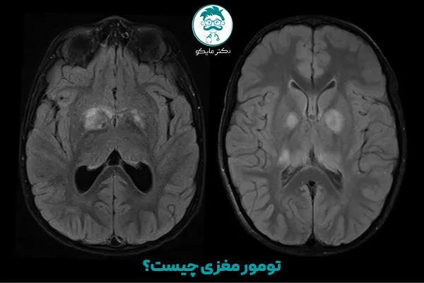 از کجا بفهمم تومور مغزی دارم؟