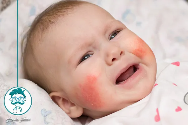 علائم پوست خشک نوزاد