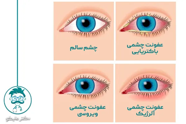 انواع عفونت چشمی