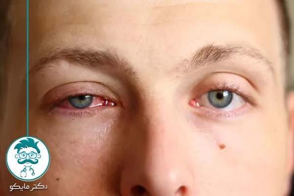 درمان خانگی عفونت چشم