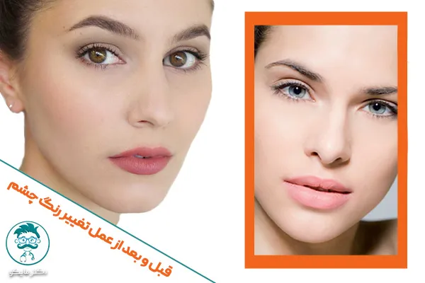 قبل و بعد از تغییر رنگ چشم