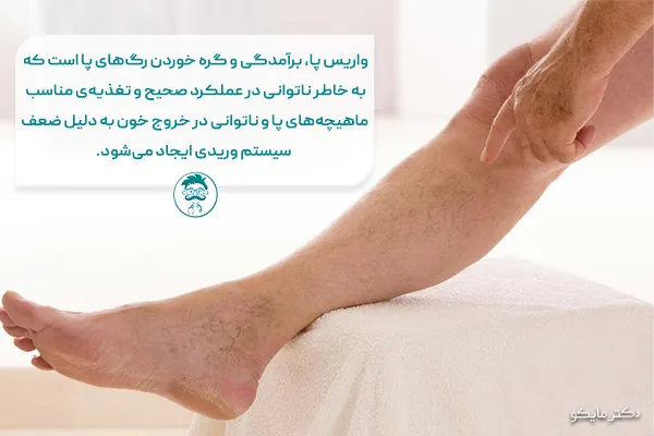 واریس پا درد دارد؟